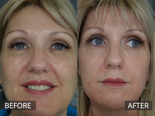 A well middle-aged lady wanted a refresh to her skin. She really wanted some of her pigmentation to be reduced. This was achieved with one treatment with Fraxel Dual (1927nm) laser. - 14