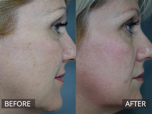 Skin pigmentation as a result of sun exposure over years has been drastically reduced with one treatment with Fraxel Dual (1927nm) Laser. This is 1 week post treatment. - 15