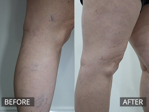 Lateral lower thigh and leg spider veins eradicated successfully with micro-sclerotherapy over a few visits. - 47