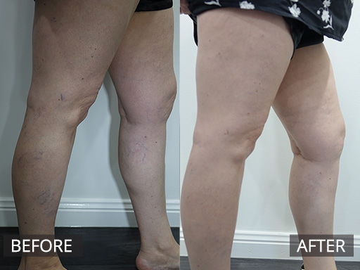 Bilateral leg and thigh spider veins treated with 5 visits of micro-sclerotherapy. - 3