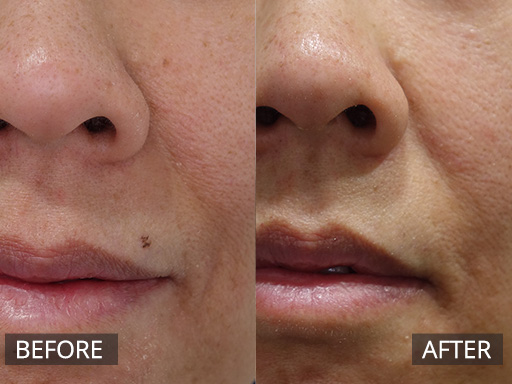 Laser Mole Removal (Upper lip area) (Alma IDAS 532nm laser) before and after 1 treatment - 3