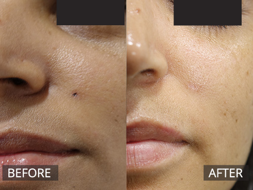 Laser Mole Removal (Alma IDAS 532nm laser) before and after 1 treatment (1 month later) - 2
