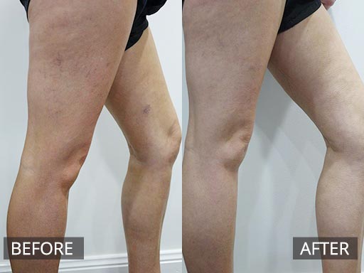 Woman wanted surface veins eradicated (pre and Post)_003 - 14