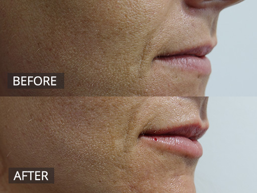 This 30-year-old lady wanted her lips to be enhanced with a natural look. Not overdone. This is immediately post 1ml of dermal filler. This should give her lasting improvement for about 6 months. - 6