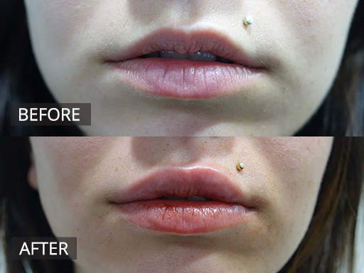 A young woman wanted more voluminous lips….instant happiness post 1ml dermal filler. - 23