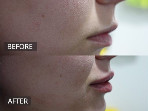 Lip filler can enhance the shape and volume of the lips. This is reflected in the post image her taken immediately post treatment. - 24