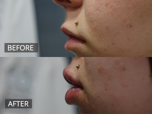 Lateral view of dermal filler lip enhancement. Before and immediately post treatment. - 10