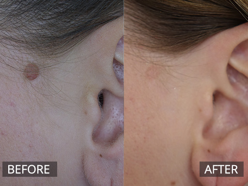 Chronic raised mole on lateral face removed with radiofrequency (Before and 2 months post) - 36
