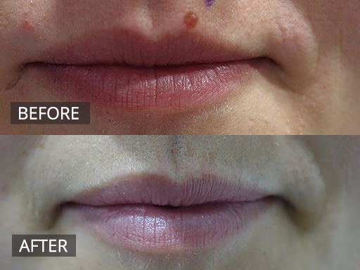 Upper lip mole removed by Ellman Radiofrequency (Before and 4 months post) - 11