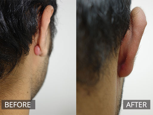 A young man with a posterior earlobe growing scar (keloid scar) debulked and 2 month’s post - 31