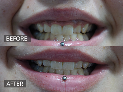 This Young woman was unhappy with her smile. She has overactive medial lip muscles that create a “Gummy smile”. This was corrected simply with anti-wrinkle injections, and giving the patient a smile to show off (2 weeks post treatment). - 1