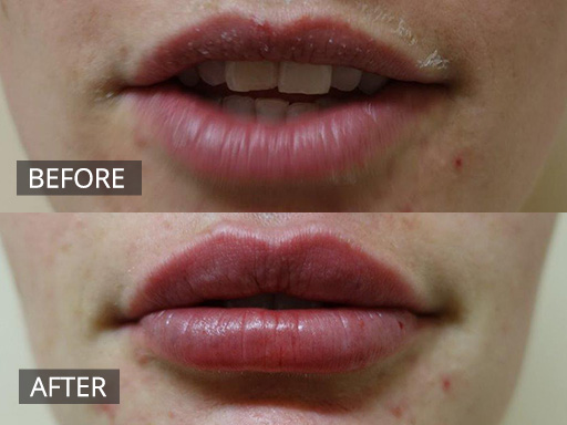 23 year old wanting more volume to her lips. She had 1ml of dermal filler. This is pre and immediately post treatment. - 19