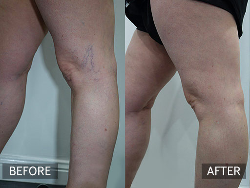 Lateral thigh spider veins treated with 3 visits of micro-sclerotherapy. And compression stocking wearing for 1 week post each treatment spaced a few weeks apart. - 1