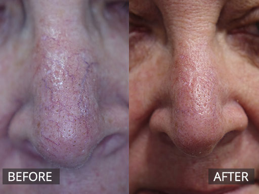 Nasal spider veins using Cutera vascular laser. This is pre and one month post treatment. - 1