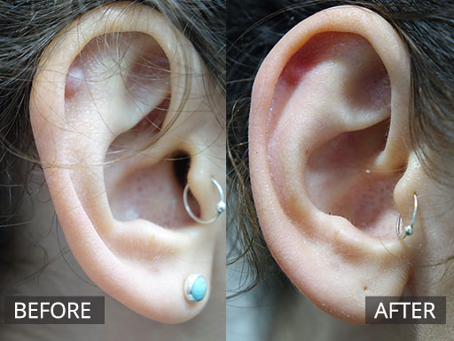 Young lady with a growing keloid scar post an ear piercing. She had this removed with surgical debulking under local anaesthetic. Photos are Pre and 1 Month post - 88