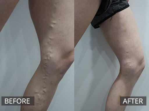 A 31 year old woman was concerned with her left thigh and leg varicose veins. This was treated non-surgically with Ultrasound guided sclerotherapy. Images are Pre and 3 & 6 weeks post - 14