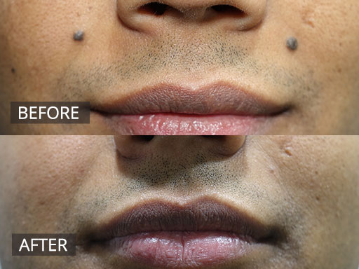 Radiofrequency and Laser Treatment to remove his 2 facial moles. (before and 8 months post) - 8