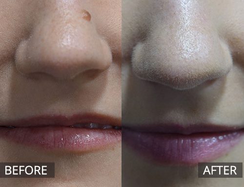 RF removal of mole on lateral nose. (Before and 2 months post) - 1
