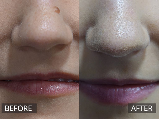 RF removal of mole on lateral nose. (Before and 2 months post) - 1