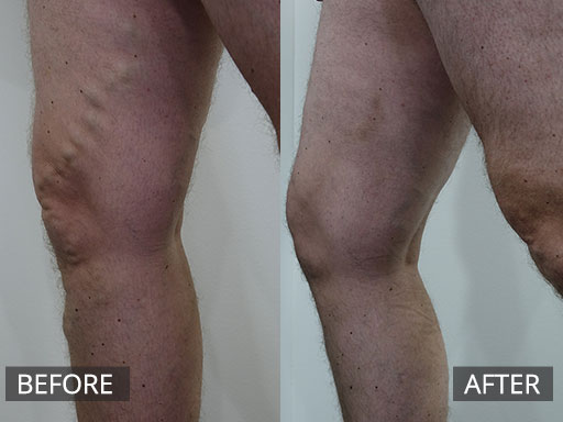 35 year old man varicose vein ultrasound sclerotherapy (Pre and 3 months post) - 6