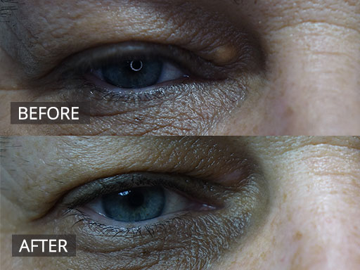 44 year old Xanthelasma removal (Pre and 3 months post) - 1