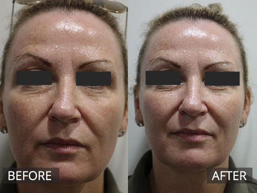 47 year old lady wanting to refresh ageing skin (Before and After one Fraxel 1927nm laser treatment) - 18