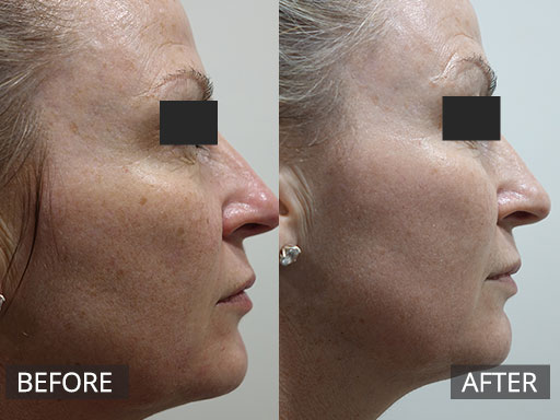 47 year old lady wanting to refresh ageing skin (Before and After one Fraxel 1927nm laser treatment) - 17
