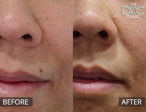 Cosmetic mole removal - mouth - 17