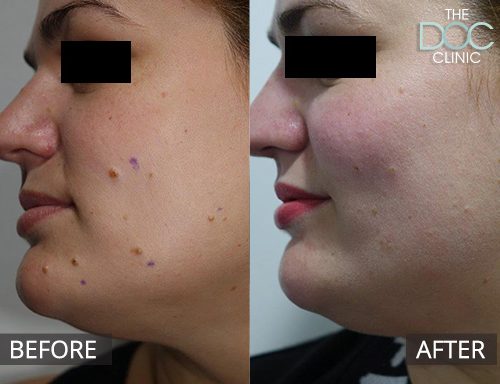 Cosmetic mole removal - mouth - 20