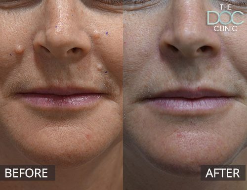 Cosmetic mole removal - mouth - 21
