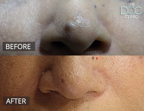 Cosmetic mole removal - nose - 26