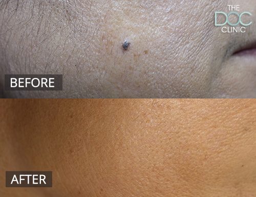 Cosmetic mole removal - other - 37