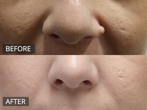 RF Mole - Chronic non changing mole on left nostril (pre and post RF removal) - 39
