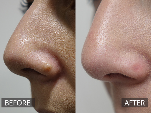 RF Mole - Chronic non changing mole on left nostril (pre and post RF removal) - 40