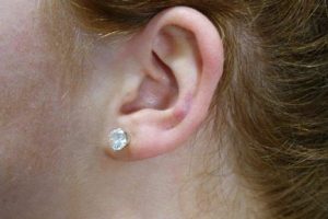 big-1 MONTH POST EAR KELOID Treatment-