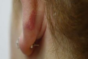 big-1 MONTH POST EAR KELOID Treatment—