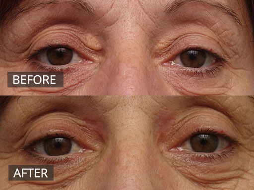 Woman in her 50's with Xanthelsma on her eyelids (pre and post treatment) - 3