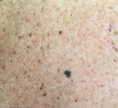 Mole Removed(Melanoma)