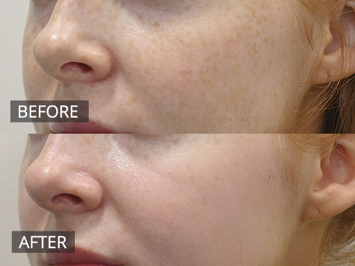 Fraxel Dual Treatment - Freckle removal (Pre & 2 Week Post) 1 - 11
