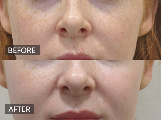 Fraxel Dual Treatment - Freckle removal (Pre & 2 Week Post) 2 - 12
