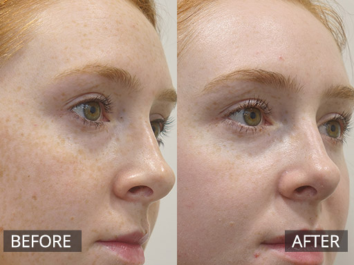 Fraxel Dual Treatment - Freckle removal (Pre & 2 Week Post) 3 - 21