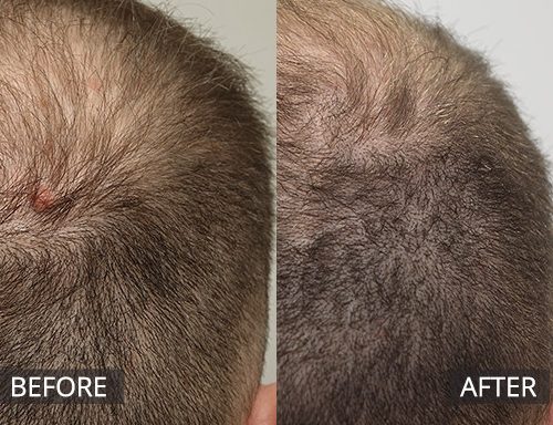 RF mole removal removed scalp mole (pre & 2months post) - 51