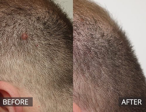 RF mole removal removed scalp mole (pre & 2months post) 02 - 52