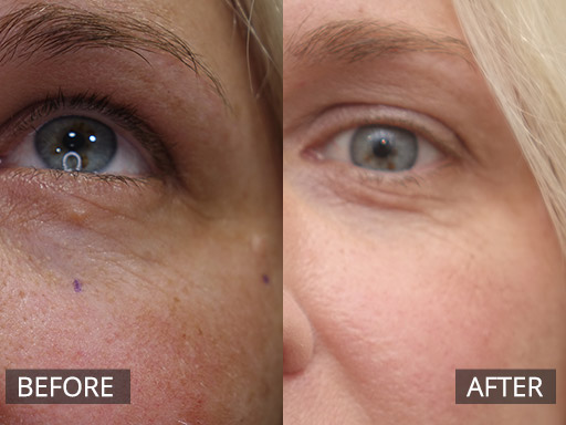 Mole removal under eyes (pre & 6month post) 02 - 48