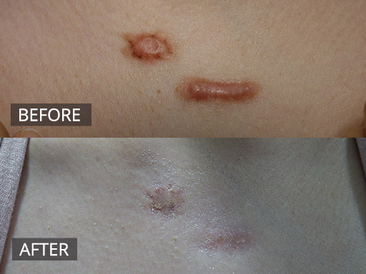 Keloid Scar Removal on chest (Pre & Post) - 63