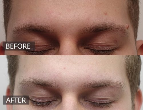 Forehead Mole removal (Pre and Post RF mole removal) 01 - 53