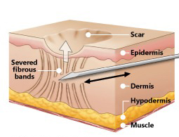 Acne Scar Treatment - 5