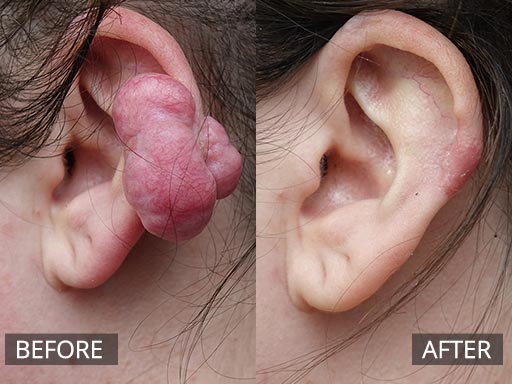 Large complicated shaped ear keloid scar post simple ear piercing in a young well woman. Patient developed this painful , itchy lump over 1 year. It was removed under local anaesthetic and followed by anti-inflammatory injections. v2 - 51