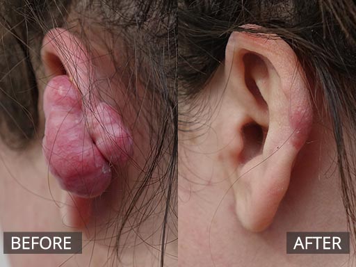 Large complicated shaped ear keloid scar post simple ear piercing in a young well woman. Patient developed this painful , itchy lump over 1 year. It was removed under local anaesthetic and followed by anti-inflammatory injections. v3 - 54