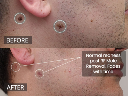 The 2 areas of Redness lateral R face and R upper lateral neck are normal healing tissues post radiofrequency mole removal - 63